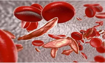 Over 4,000 Sierra Leoneans Diagnosed with Sickle Cell Disease