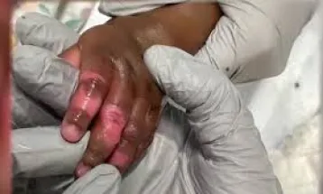 Aunt Burns 6-Year-Old's Hands for Spilling Baby Perfume