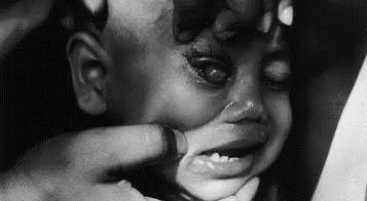 Measles in Children: High Risks and Potential for Blindness