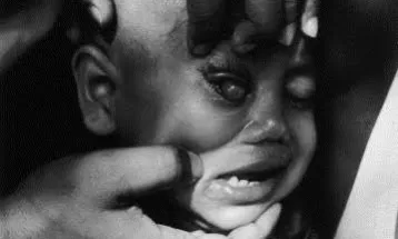 Measles in Children: High Risks and Potential for Blindness
