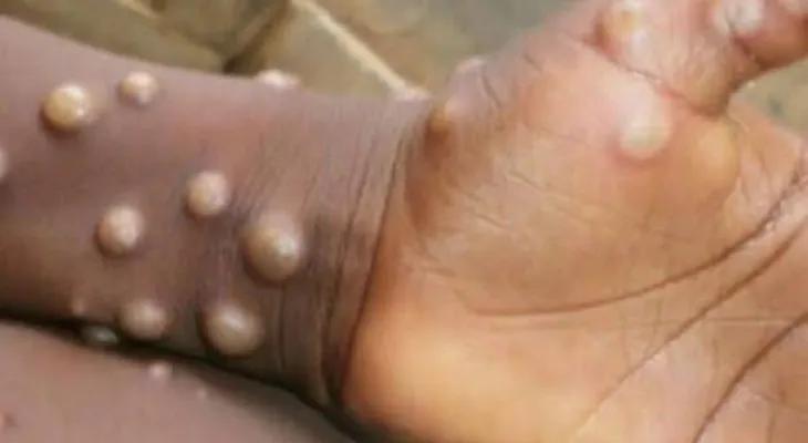 13 New Mpox Cases in Sierra Leone as Total Infections Surpass 4,000